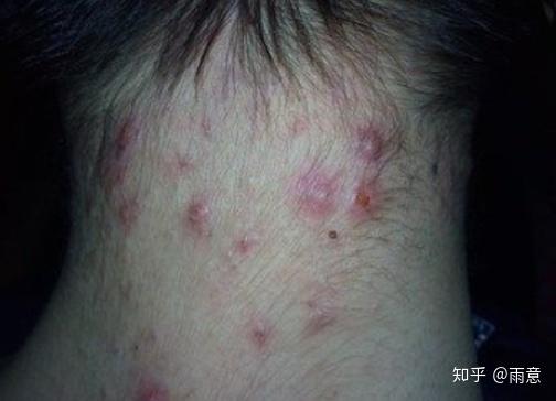 先说说我用的那些外用药