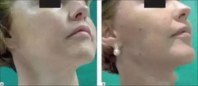 肉毒毒素， 治疗腋臭的新宠儿