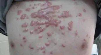 ② 茎杆流脓水——多半是青枯病