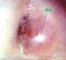 猪肛肿病是猪只常见疾病，由细菌感染引起