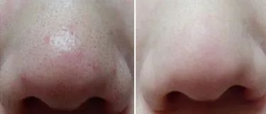 揭秘“一喷就红”：那些让你脸红的成分