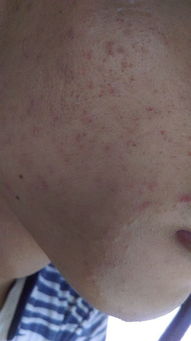 荨麻疹：Neng否彻底根治？