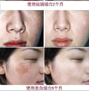 常见水果祛斑成分大盘点