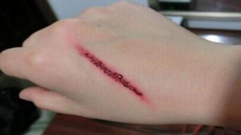 人体伤口Zui怕的农药揭秘