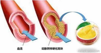茶油：揭秘其如何助力动脉粥样硬化斑块逆转之道