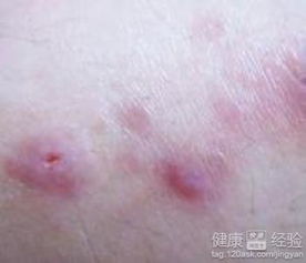 去医院还是在家治疗