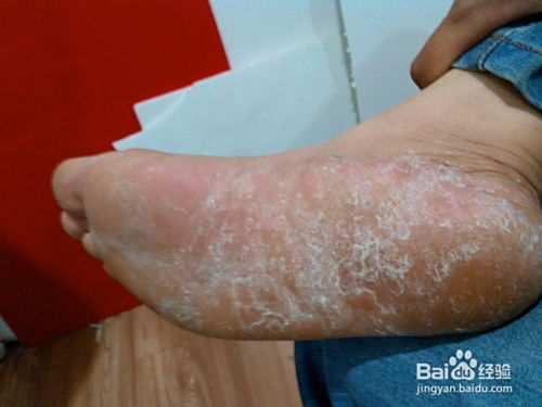 脚气反复发作， 用药护理须知