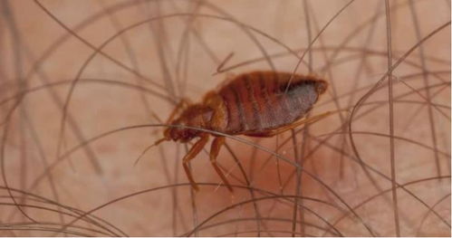 床虱子用药视频