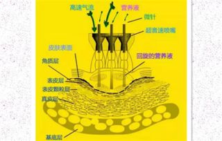 无针注射原理何在？如何突破传统注射的局限
