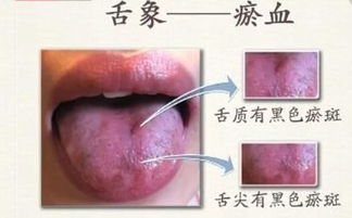 花斑舌，舌尖有斑