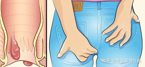 菊花痒痒怎么回事呢？是过敏还是感染