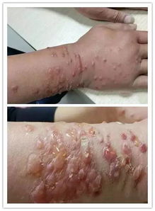 打农药后手背起水泡的原因及处理方法