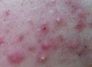 痘痘的处理小窍门：碘伏的妙用还是禁地？