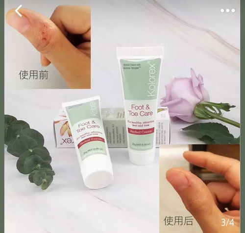 好力克戊唑醇治疗哪些真菌感染病症效果较好？