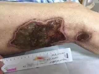 如何判断是否烧根？