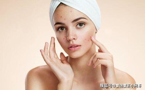 先说说 我们要知道痘痘是怎么来的