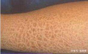 鱼鳞病：皮肤上的树皮印记， 揭秘其成因
