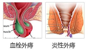 肛门菊花褶子肿，是痔疮还是炎症