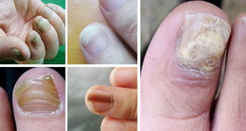 灰指甲，这个让人头疼的小东西