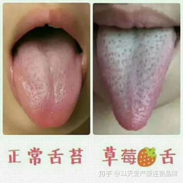 花斑舌，舌尖有斑