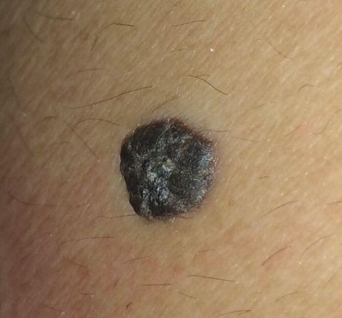 打农药后身上起脓包和小红点的原因分析