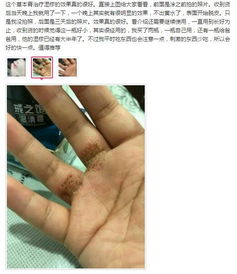 用手摸了多菌灵后皮肤不适，会导致中毒吗？