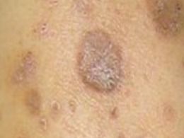 遗传的阴影：鱼鳞病与基因的秘密