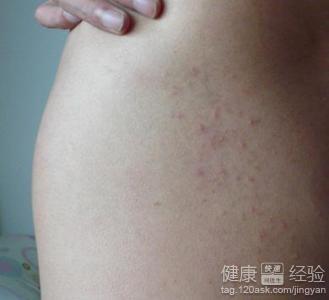 菊花周边痒是过敏吗？日常护理你做对了吗