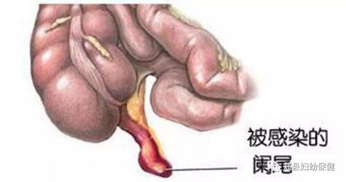 急性阑尾炎：腹痛加剧