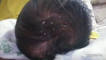 氟虫腈：破坏螨虫神经系统和呼吸系统