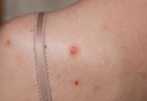 医生建议，治疗为主