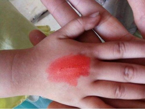 3. 观察伤口， 防范感染