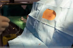 猪钳闭性脐疝手术关键步骤解析