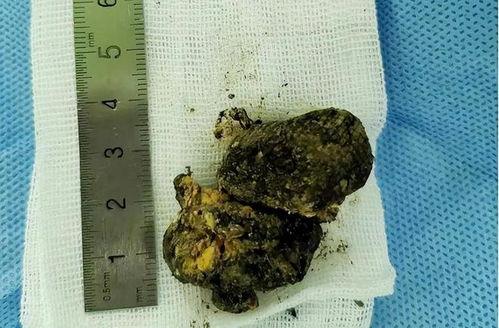 鸵鸟胃阻塞：指鸵鸟因摄入异物或食物不当导致胃部阻塞的疾病