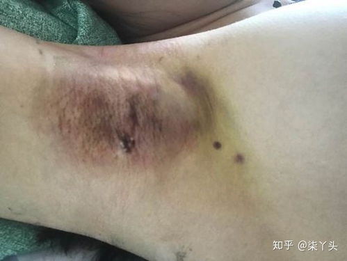 狐臭，了解一下