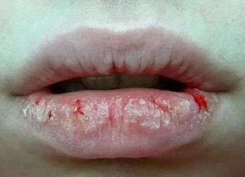 孩子嘴角发红起皮， 嘴唇干裂，揭秘背后的原因