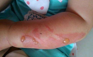 烧烫伤修复，植物力量大揭秘！