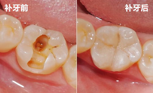 补牙选哪种树脂好？结实耐用是关键