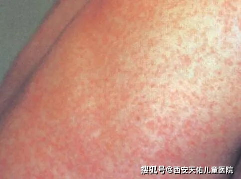 孩子玩杀虫剂身上起疹子，原因竟是这样！