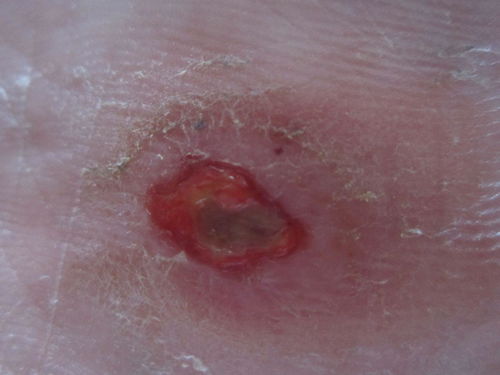 二、三天后的症状表现