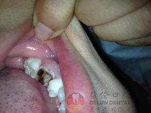 牙根烂了拔牙后的处理方法：牙齿的再生之旅