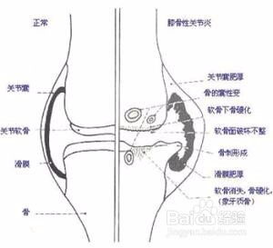 治疗关节炎，得讲究方法