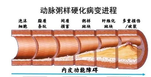 茶油：揭秘其如何助力动脉粥样硬化斑块逆转之道