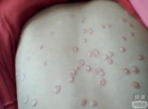 皮肤干燥， 维生素A的缺失