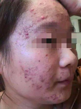 痘痘的反复折磨