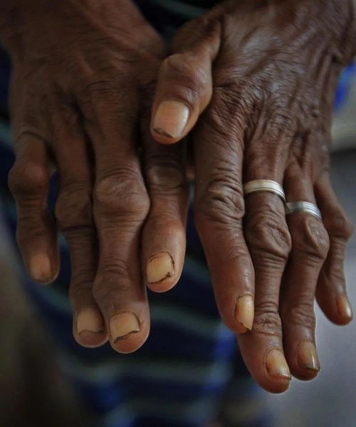 灰霉病，它到底有多可怕？