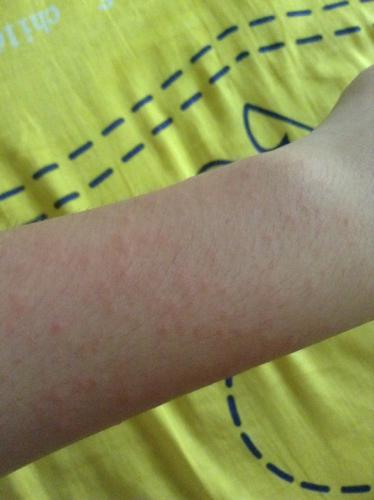 荷尔蒙作怪，也可Neng导致脸红