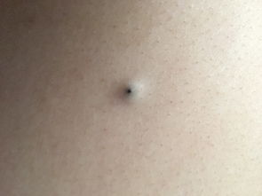 枣锈病的“小疙瘩”长什么样？