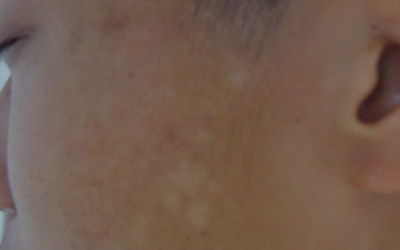 ① 叶背长白毛——霜霉病找上门