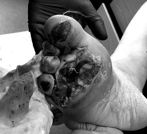 Q：切口发黑怎么救？